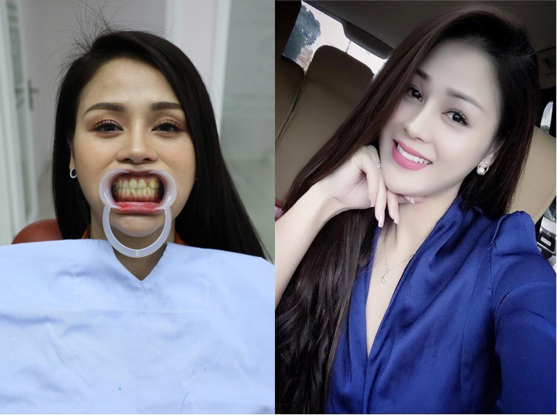 Cô nàng đã từng công khai chuyện đi chỉnh sửa hàm răng. Với nghệ sĩ, việc độ răng sứ giờ đây đã là chuyện bình thường.