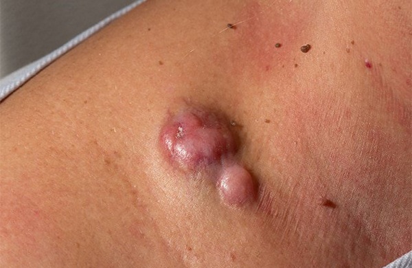 Sarcoma ác tính rất hiếm gặp. 