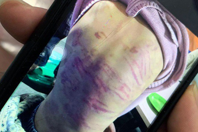 Những vết thương trên người cháu N. Ảnh: Dân Trí