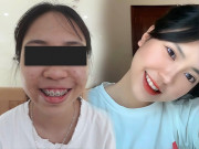 Làm đẹp - Cô giáo gây bão mạng với màn "độ" răng lởm chởm, nhan sắc thăng hạng gây tranh cãi