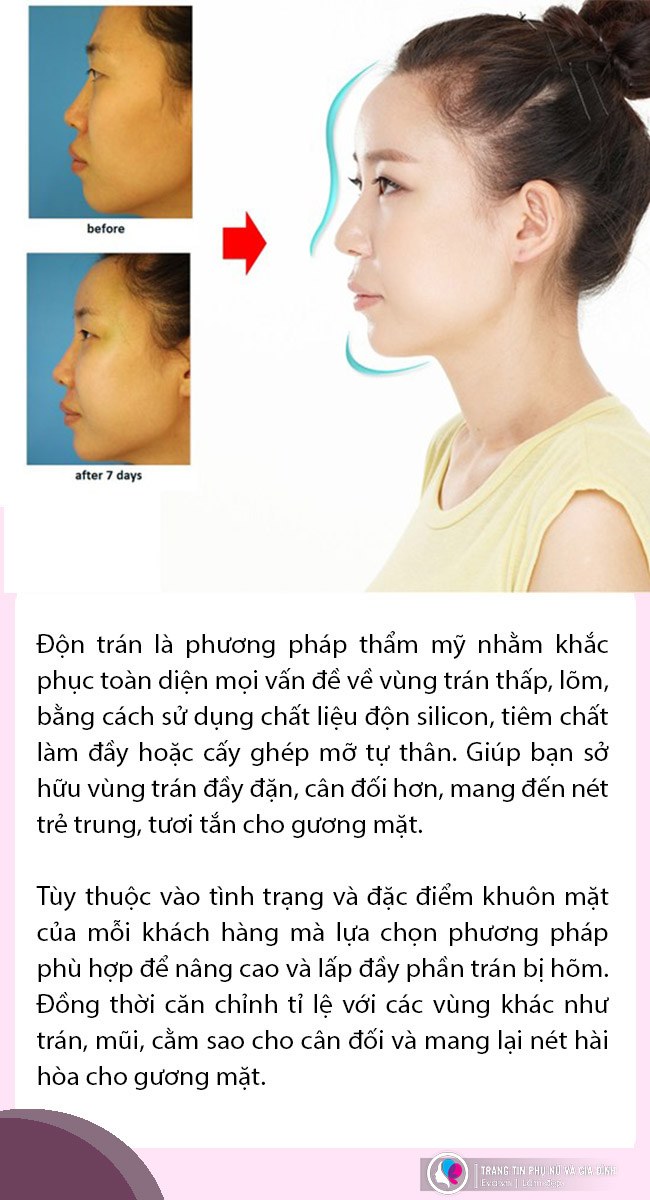 Đi độn trán, chưa thấy vầng trán thanh lịch đâu, cô nàng nhận về cái kết sưng như ong chích - 5