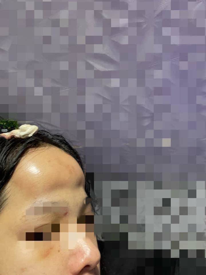 Góc nghiêng có thể thấy cả 1 vùng da lồi lên nhấp nhô. Đường viền trán hơi bị tấy đỏ.