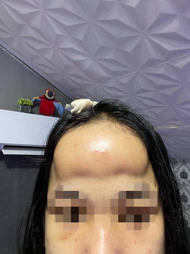 Dù chỉ chia sẻ hình ảnh đi độn trán bị sưng và không nói gì thêm nhưng ai nấy có thể cảm nhận được sự đau đớn mà cô nàng này đang chịu đựng.