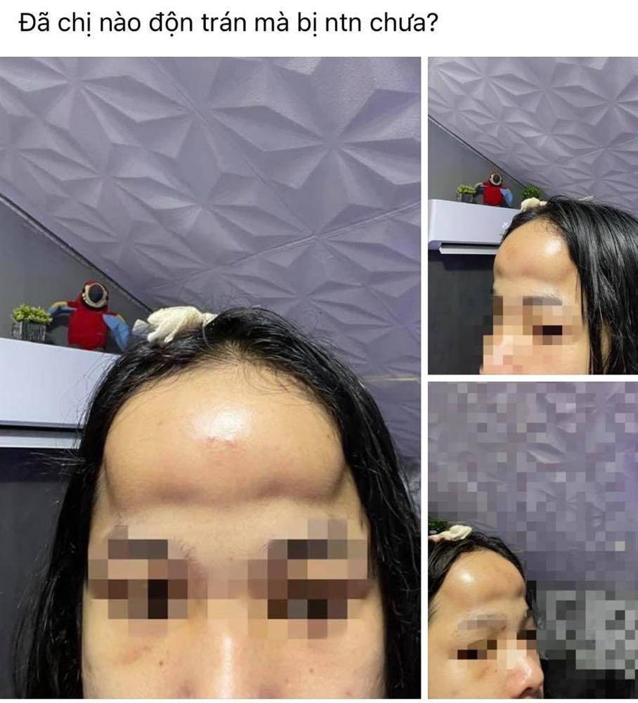 Chuyện các ca phẫu thuật thẩm mỹ hỏng phải đăng đàn kêu cứu như cô nàng này không còn lạ. Trường hợp trán sưng đến muốn vỡ như này không khỏi khiến nhiều người giật mình.