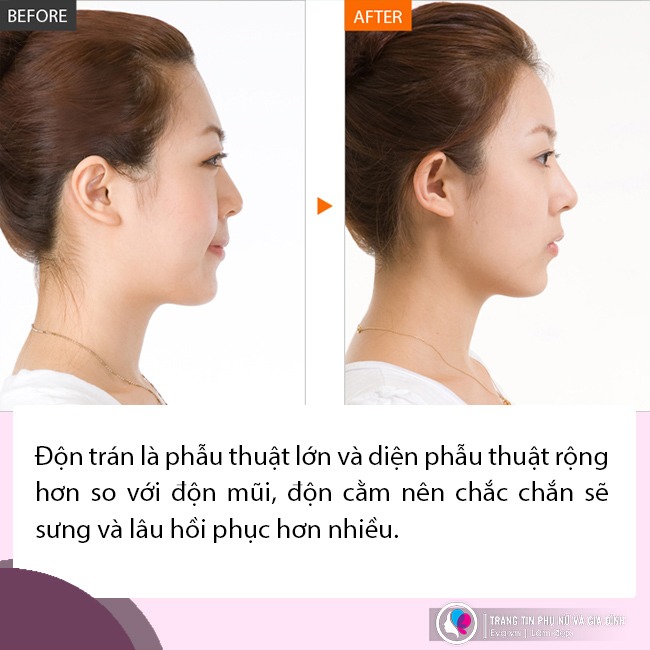 Đi độn trán, chưa thấy vầng trán thanh lịch đâu, cô nàng nhận về cái kết sưng như ong chích - 9