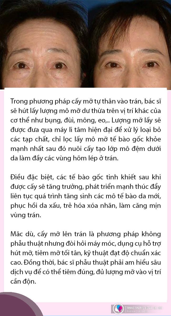 Đi độn trán, chưa thấy vầng trán thanh lịch đâu, cô nàng nhận về cái kết sưng như ong chích - 7