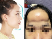 Làm đẹp - Đi độn trán, chưa thấy vầng trán thanh lịch đâu, cô nàng nhận về cái kết sưng như ong chích