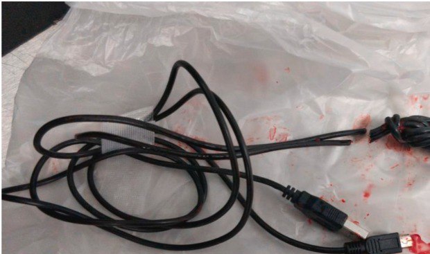 Sợi dây cáp sau khi được lấy ra khỏi bộ phận sinh dục của cậu bé. 