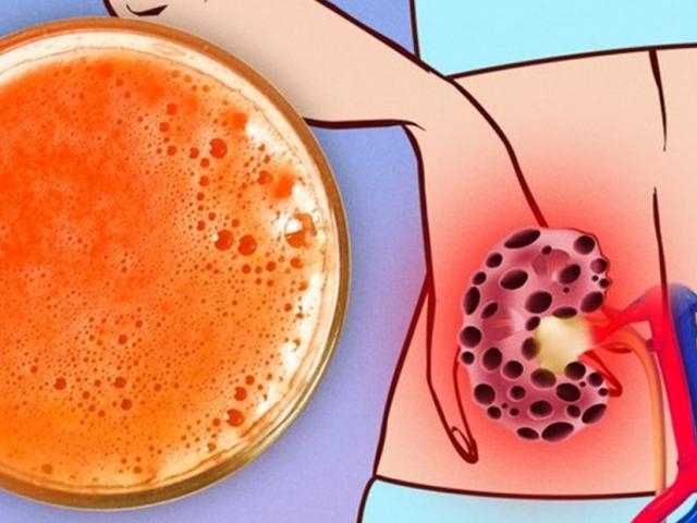 7 thực phẩm càng ăn càng hại thận, nhiều loại người Việt vô tư dùng hàng ngày