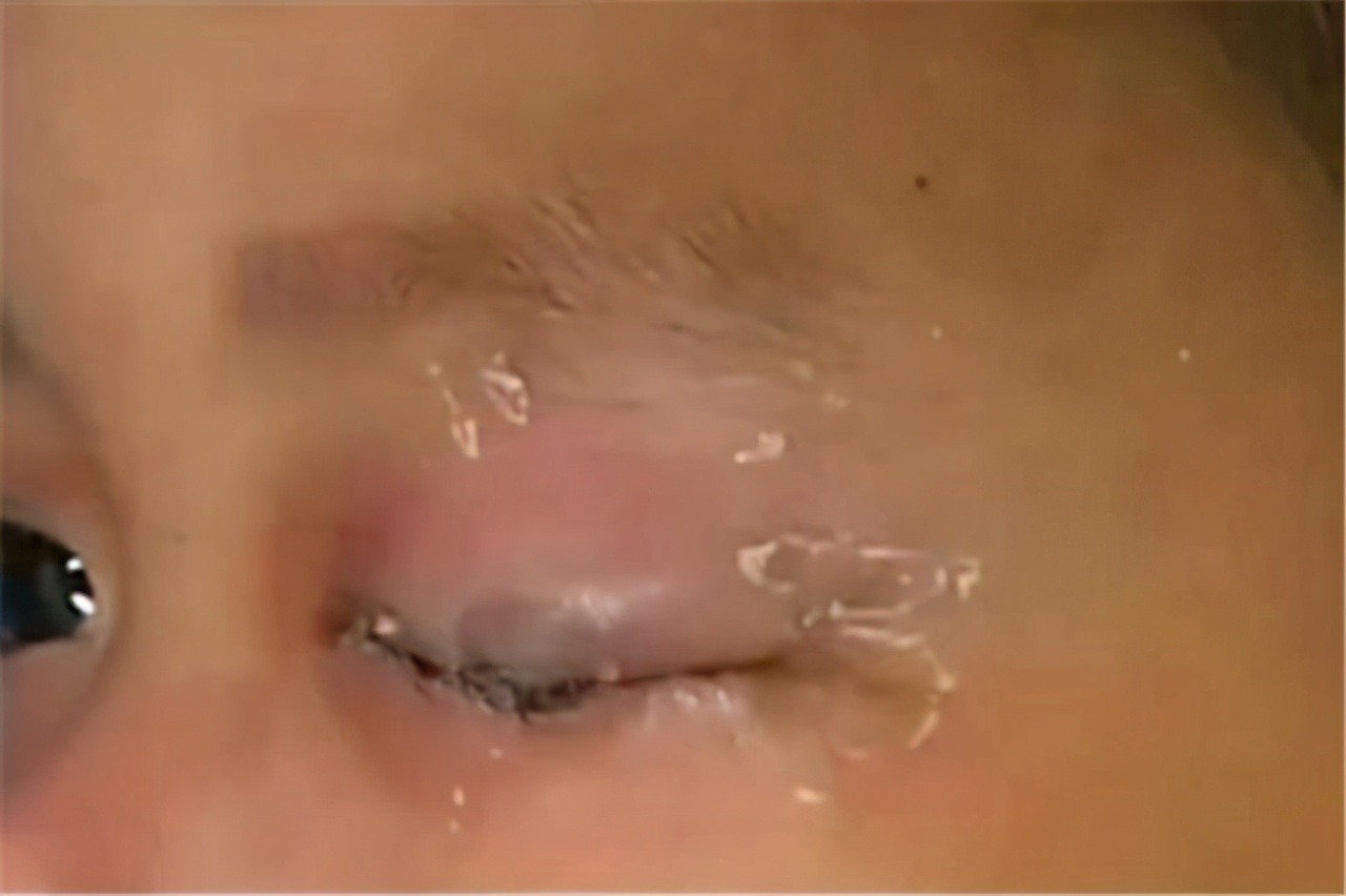 Triệu chứng khi bị keo dán sắt dính vào mắt