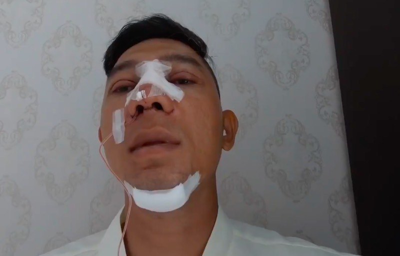 Lương Bằng Quang không ngại công khai gương mặt sau khi vừa phẫu thuật thẩm mỹ.