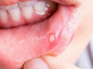 Nhiệt miệng ăn gì để vết loét nhanh lành? Một số món càng ăn nhiệt miệng càng lâu khỏi