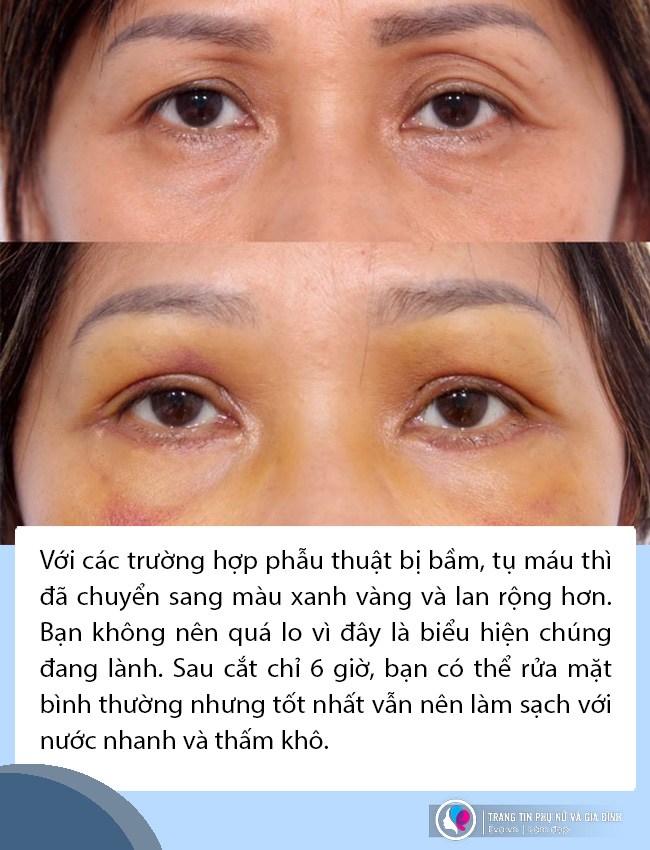 Phẫu thuật vùng mặt xong cần chăm sóc da và trang điểm thế nào để vừa xinh mà vẫn khoẻ? - 5