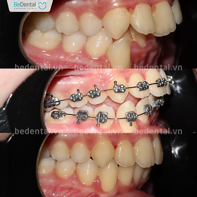 Nha khoa Thẩm mỹ Bedental - Địa chỉ niềng răng trả góp uy tín thủ tục đơn giản - 3