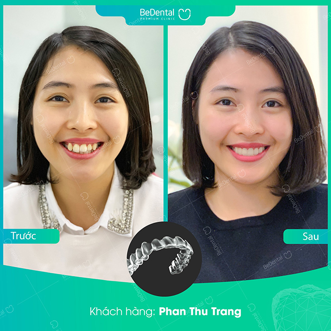 Nha khoa Thẩm mỹ Bedental - Địa chỉ niềng răng trả góp uy tín thủ tục đơn giản - 5