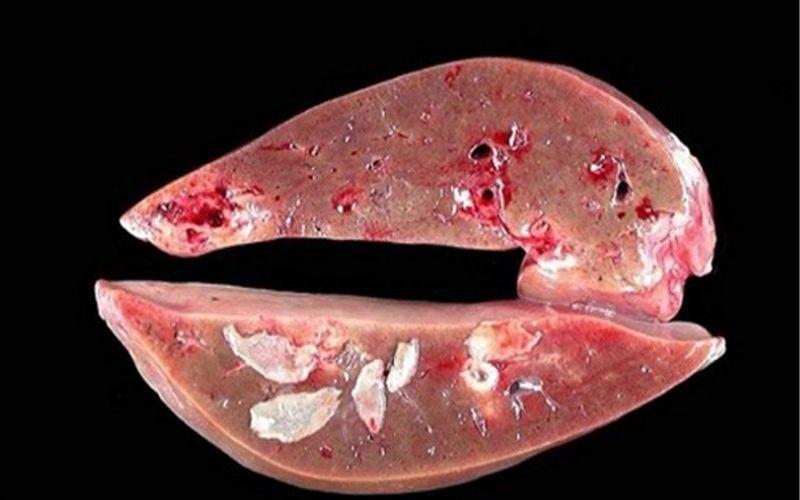 Bé trai 6 tuổi khám sức khỏe phát hiện amp;#34;bệnh sán lá ganamp;#34;, ai cũng bất ngờ khi biết nguyên nhân - 2
