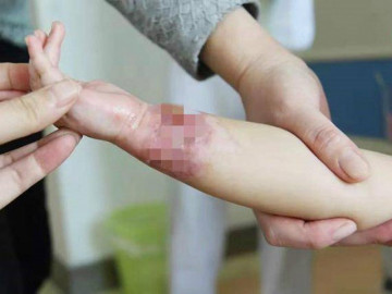 Con bị bỏng tróc da tay, mẹ liền dội thêm một thứ lên, bác sĩ vỗ tay khen