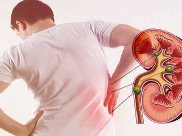 Thận teo mỏng như tờ giấy vì những thói quen nhiều người hay mắc