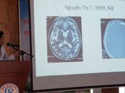 Sức khỏe - Hàng loạt ca Covid-19 áp xe, hoại tử sọ mặt