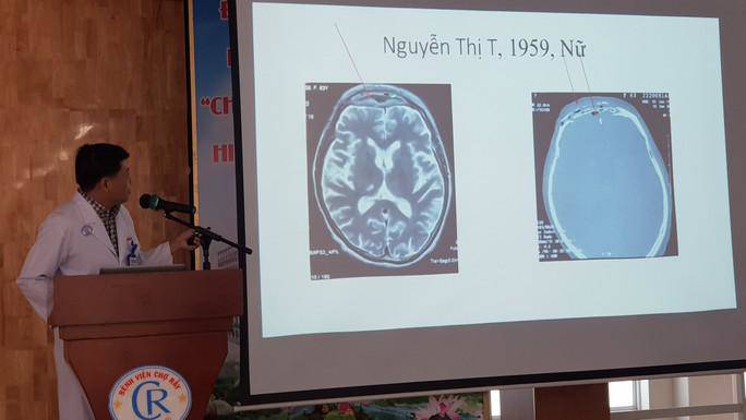 Hàng loạt ca Covid-19 áp xe, hoại tử sọ mặt vừa được công bố