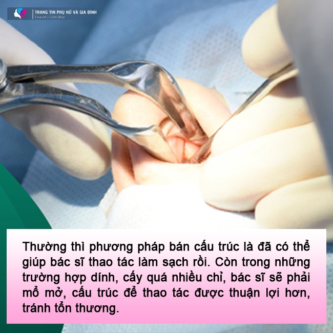 Ths.Bs Cao Duy: amp;#34;Tôi đã bị hỏng tới 2 cái pank, tốn 2-3 tiếng đồng hồ để tháo sụn mũi sinh họcamp;#34; - 7