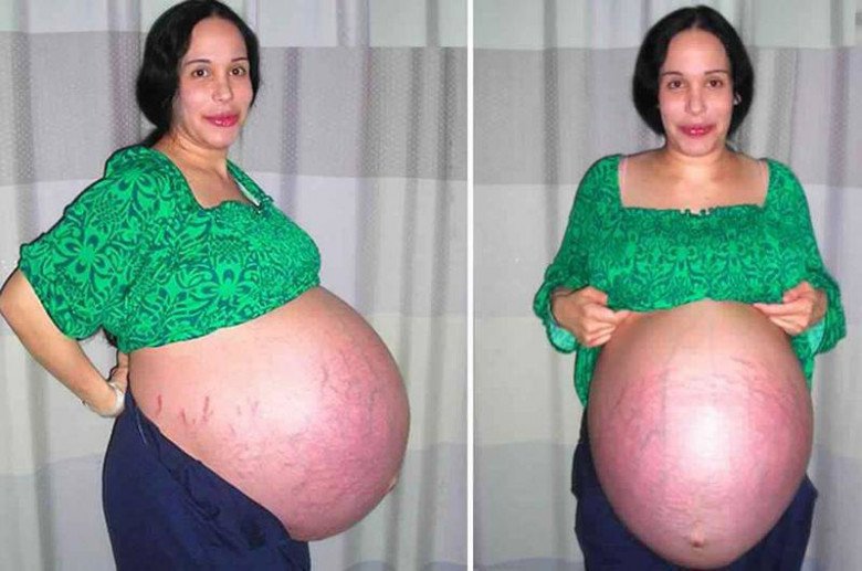 Mang thai 8, mẹ bầu gãy xương sườn khi sinh amp;#34;đàn conamp;#34; gây chấn động thế giới - 2