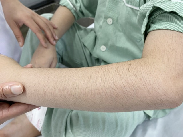 Bé trai Bắc Giang bỗng rậm lông sau một tháng dùng thứ này, BS cảnh báo điều phụ huynh cần tránh