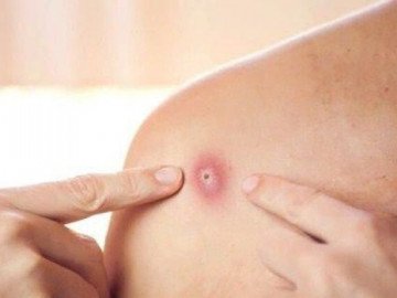 Nóng: Nguy cơ bệnh đậu mùa khỉ xâm nhập Việt Nam, Bộ Y tế họp khẩn