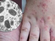 Sức khỏe - Tốc độ lây nhiễm của đậu mùa khỉ và SARS-CoV-2 khác nhau thế nào?