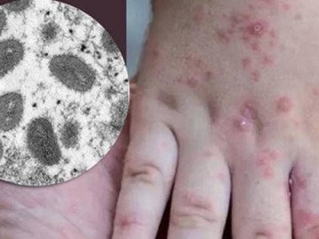 Tốc độ lây nhiễm của đậu mùa khỉ và SARS-CoV-2 khác nhau thế nào?