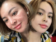 Làm đẹp - Vừa xong màn peel da như rắn lột da, Trang Nemo lại cắt khóe miệng như Joker