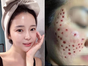 Tiêm meso trẻ hoá da mặt, gái xinh nhận về gương mặt rỗ như tổ ong, chuyên gia cảnh tỉnh