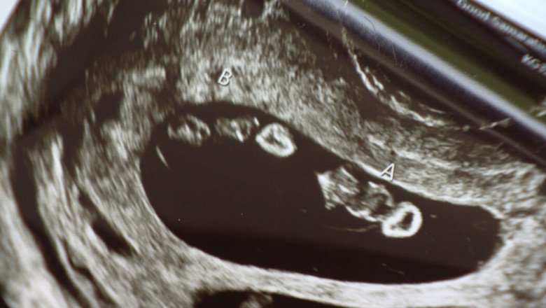 Mẹ sinh cùng lúc 2 cặp song thai, bác sĩ tấm tắc 70 triệu ca mới có một - 3