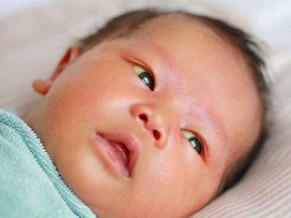 Trẻ sơ sinh bị vàng da vàng mắt và những điều cần biết - 1