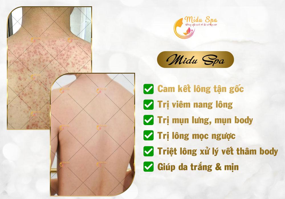 Midu Spa triệt lông hiệu quả