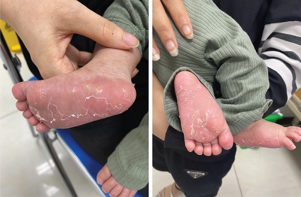 Hình ảnh bong tróc da chân của cháu bé. Ảnh: BSCC.