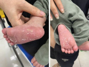 Sức khỏe - Bé 1,5 tháng tuổi ở Hải Dương mắc giang mai, xét nghiệm bố mẹ mới biết sự thật không ngờ