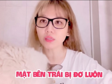 Tình trạng liệt nửa mặt ở Hari Won: Nhiều người dễ mắc vì quá chủ quan với sức khỏe