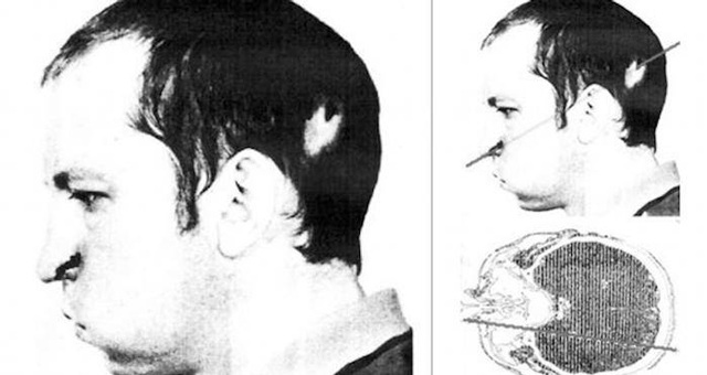 Người đàn ông sở hữu amp;#34;khuôn mặt âm dươngamp;#34;, một nửa mặt già đi, nửa còn lại vẫn trẻ măng - 1