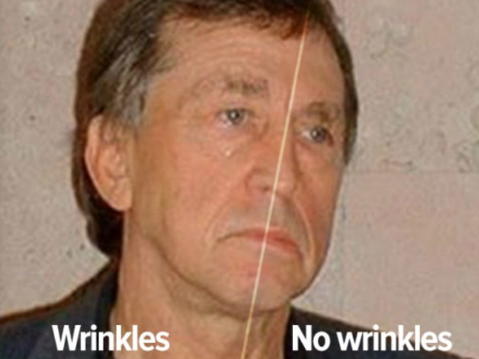 Anatoli Bugorski sở hữu khuôn mặt với một bên có nếp nhăn (Wrinkles) và một bên không có nếp nhăn (No wrinkles)
