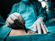 Sức khỏe - Người phụ nữ 46 tuổi hoại tử bụng sau tiêm tan mỡ, thẩm mỹ viện nói “do còn trinh”