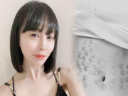 Làm đẹp - Nữ diễn viên Nhật Bản bị bỏng da khi đi... triệt lông vùng bụng