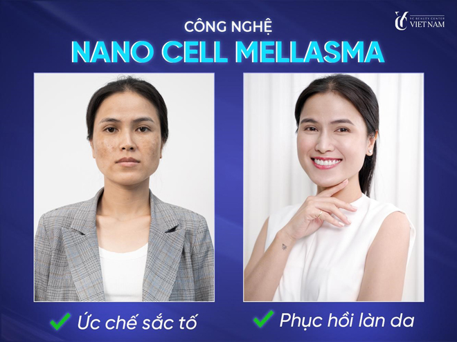Hình ảnh trước và sau của khách hàng khi đến điều trị nám bằng công nghệ Nanocell Melasma tại Phòng khám da liễu Quốc tế YC
