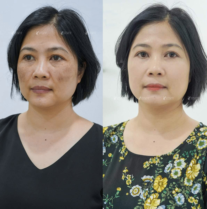 Công nghệ trị nám Nanocell Melasma - Vực dậy niềm tin chữa nám cho hàng triệu chị em  - 3