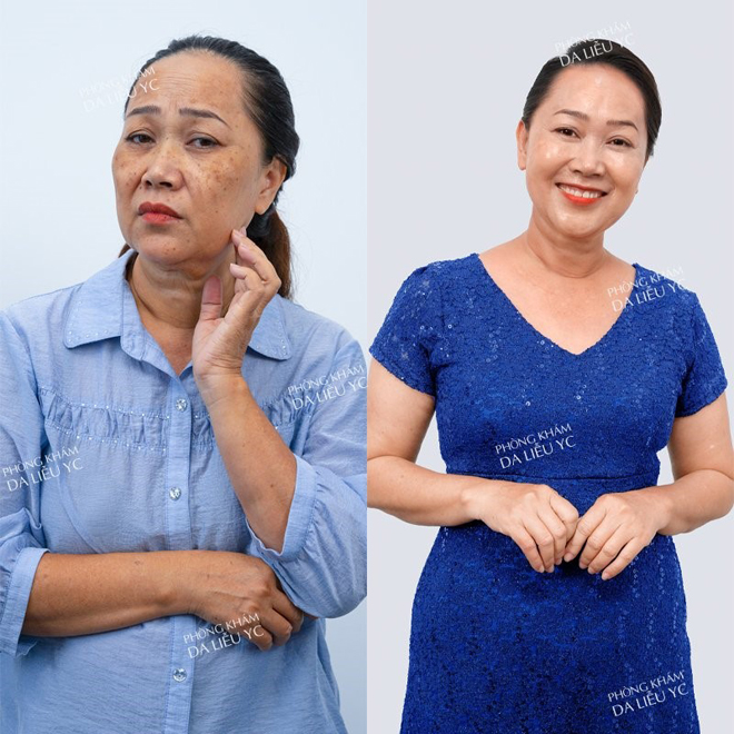 Công nghệ trị nám Nanocell Melasma - Vực dậy niềm tin chữa nám cho hàng triệu chị em  - 4