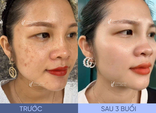 Hình ảnh trước - sau của KH khi điều trị nám tại YC 