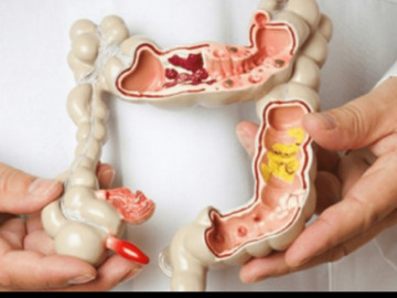 Nhiều người mắc ung thư nhưng tưởng bị trĩ, bác sĩ chỉ cách phân biệt để không nhầm lẫn