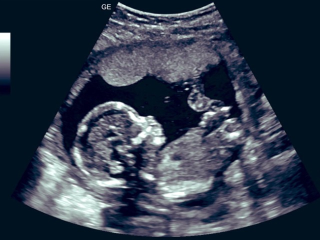 Suốt ngày bị chồng mắng chửi vì hiếm muộn, vợ bàng hoàng khi kiểm tra cái thai trong bụng