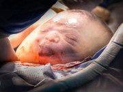 Bà bầu - Gặp lại cậu bé từng "gây sốt" với bức ảnh chào đời trong bọc ối, lè lưỡi "trêu" bác sĩ