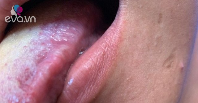 Người đàn ông trẻ tưởng bị nhiệt miệng hóa ung thư lưỡi, BS cảnh báo 2 thói quen gây ung thư ít người để ý